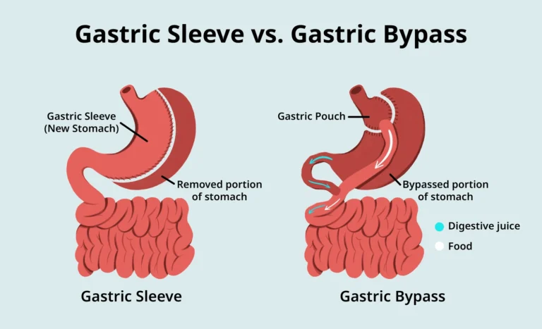 Gastric Sleeve vs Gastric Bypass Surgery