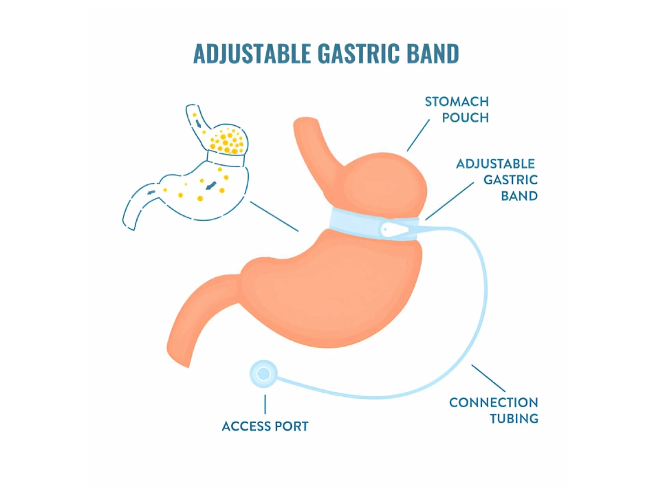 Adjustable Gastric Band Surgery by Dr. Sherif Awad