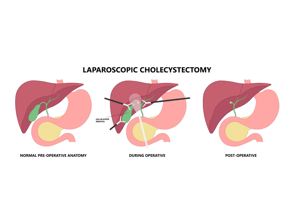 Laproscopic Cholecystetomy