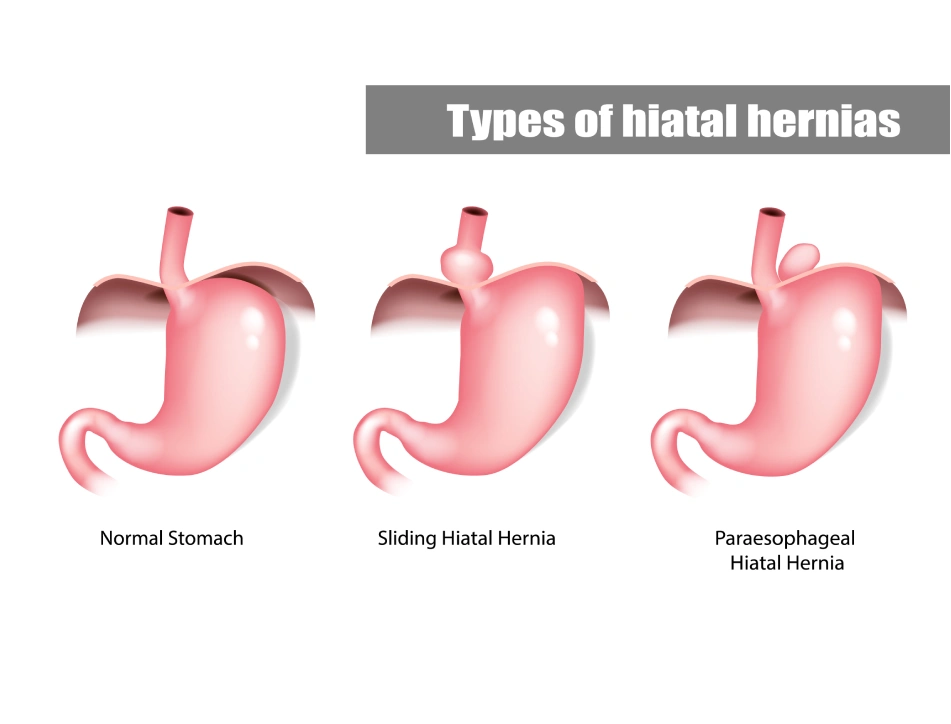 Type of Hiatal Hernia