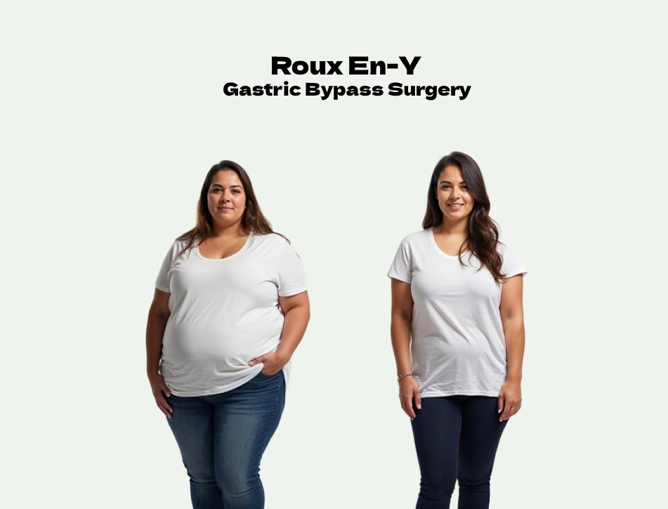 Roux En-Y Gastric Bypass Surgery