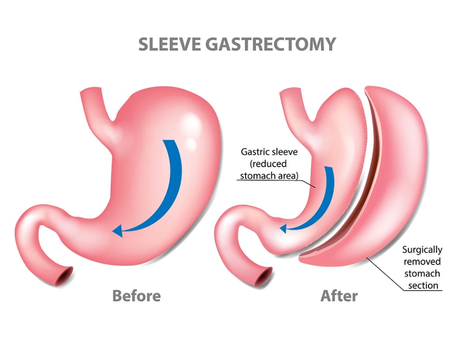 Laparoscopic Sleeve Gastrectomy Dubai