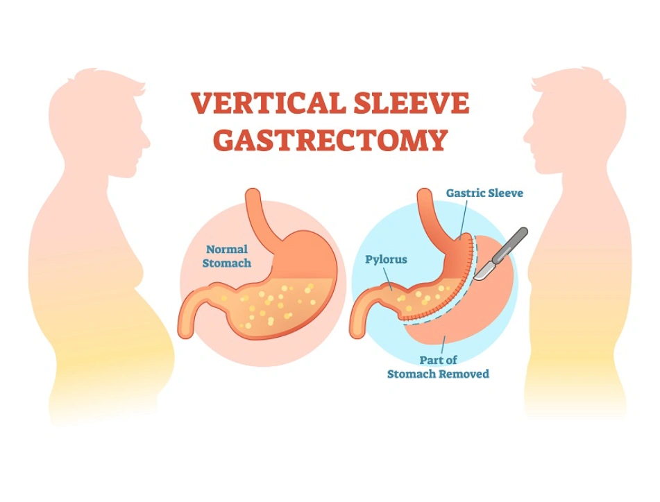 Laparoscopic Sleeve Gastrectomy Dubai