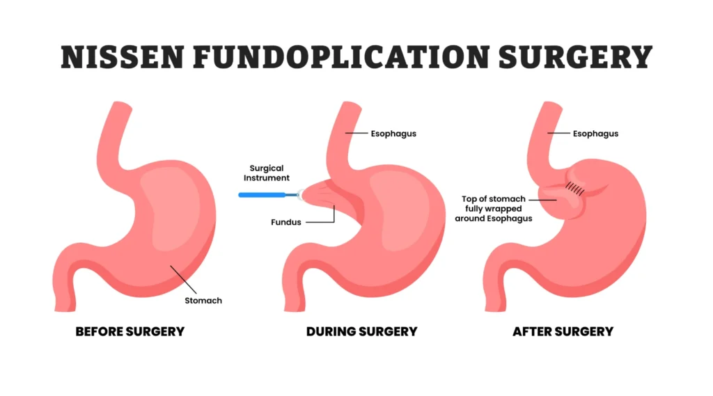 Laparoscopic Nissen Fundoplication procedure for GERD treatment