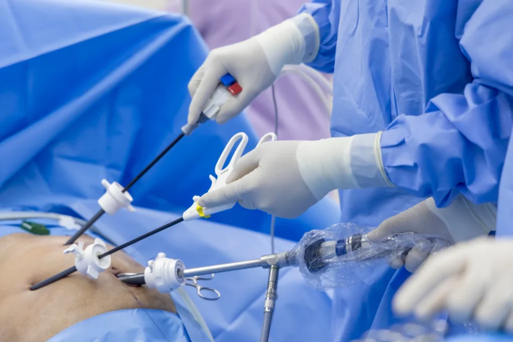 Dr Sherif Awad performing laparoscopic gallbladder surgery in Dubai