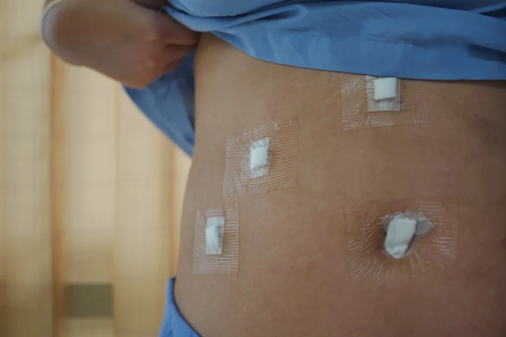 Wounds after gallbladder surgery