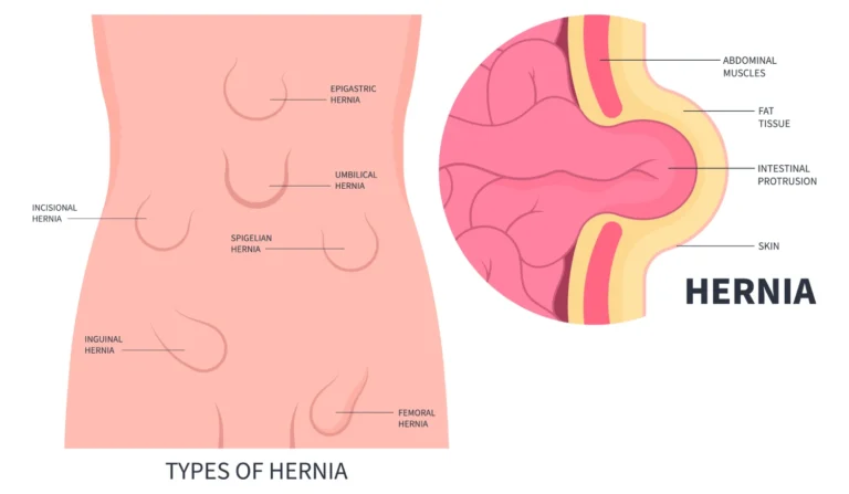 Comparison of open and laparoscopic hernia repair techniques