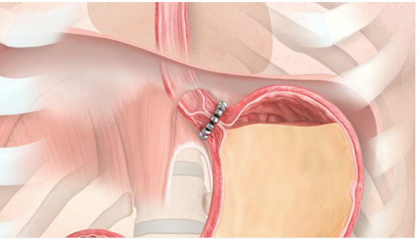 Surgical Treatment for Acid Reflux