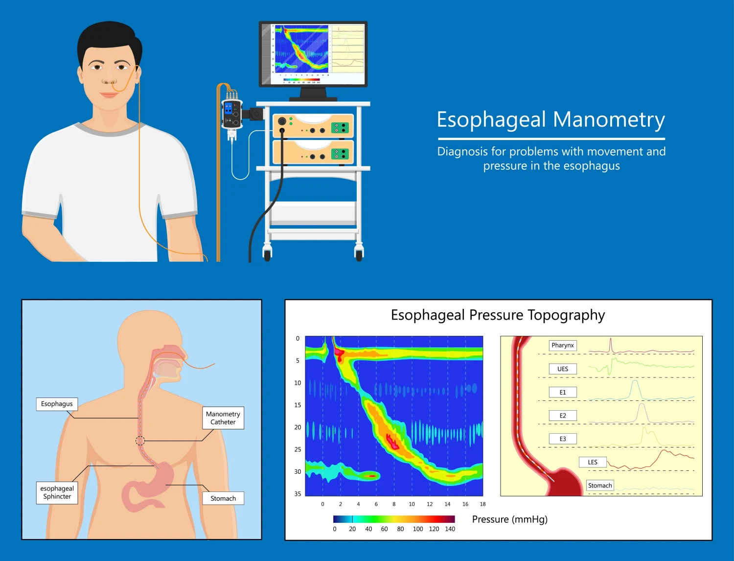 Illustration of an esophageal manometry test showing how muscle movement and swallowing function are measured