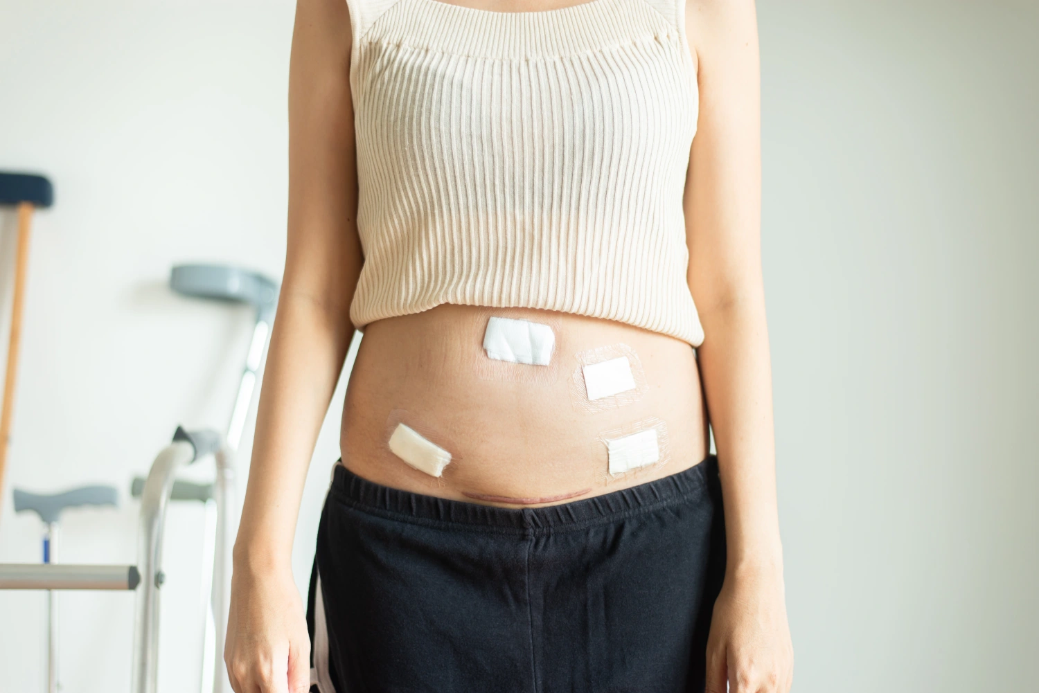 Proper incision and wound care after laparoscopic abdominal surgery