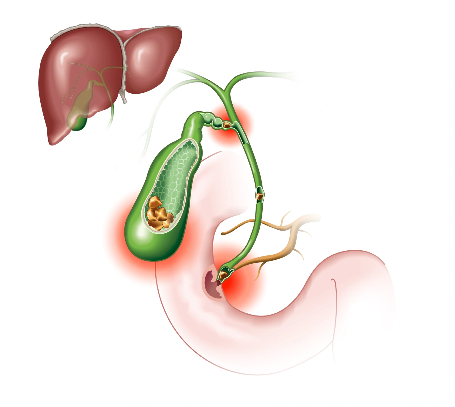gallstones blocking bile duct and pancreatic duct. Labeled Illustration