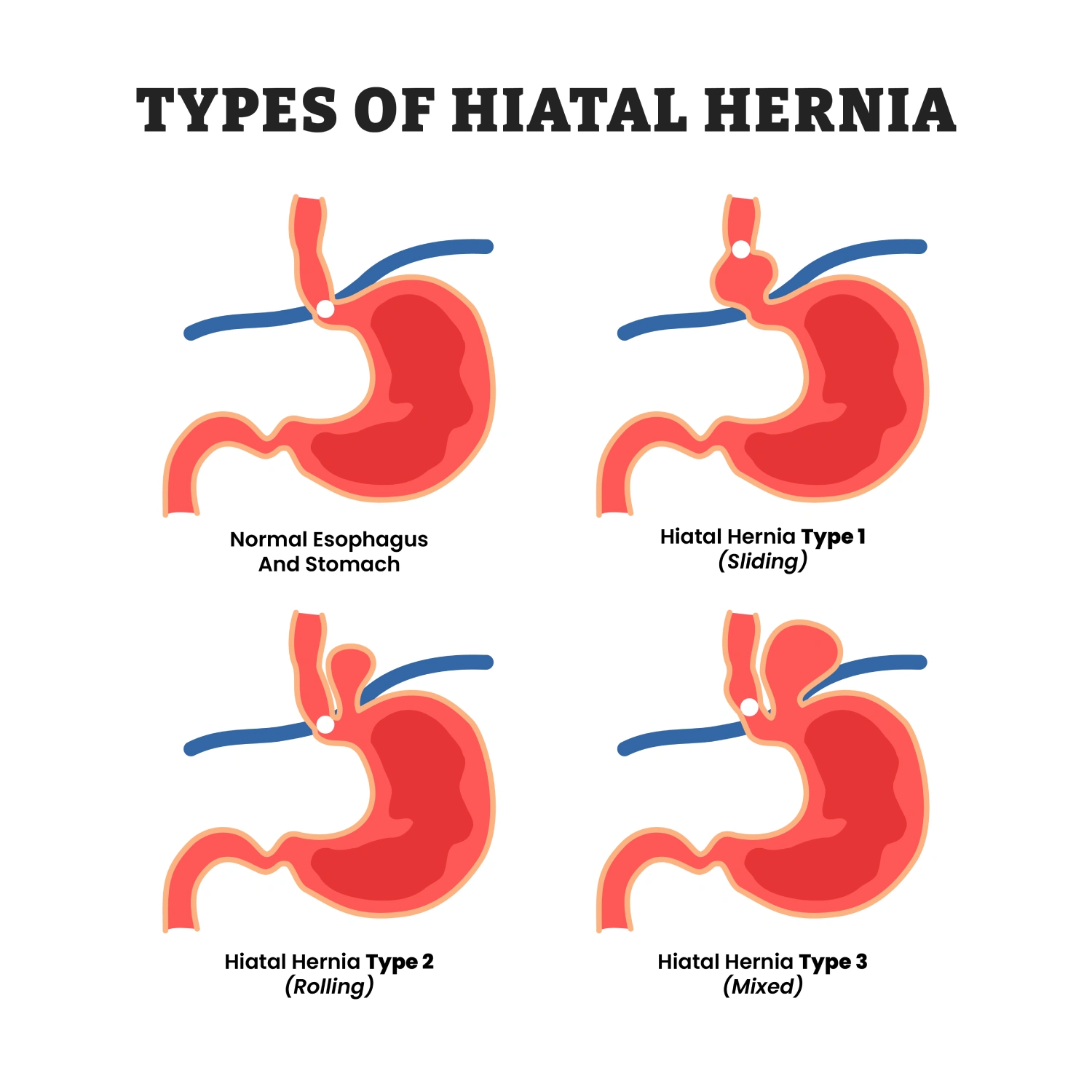 Different types of hiatal hernia types