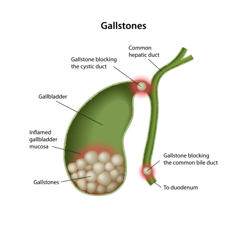 Gallstones forming inside the gallbladder due to cholesterol and bile imbalance
