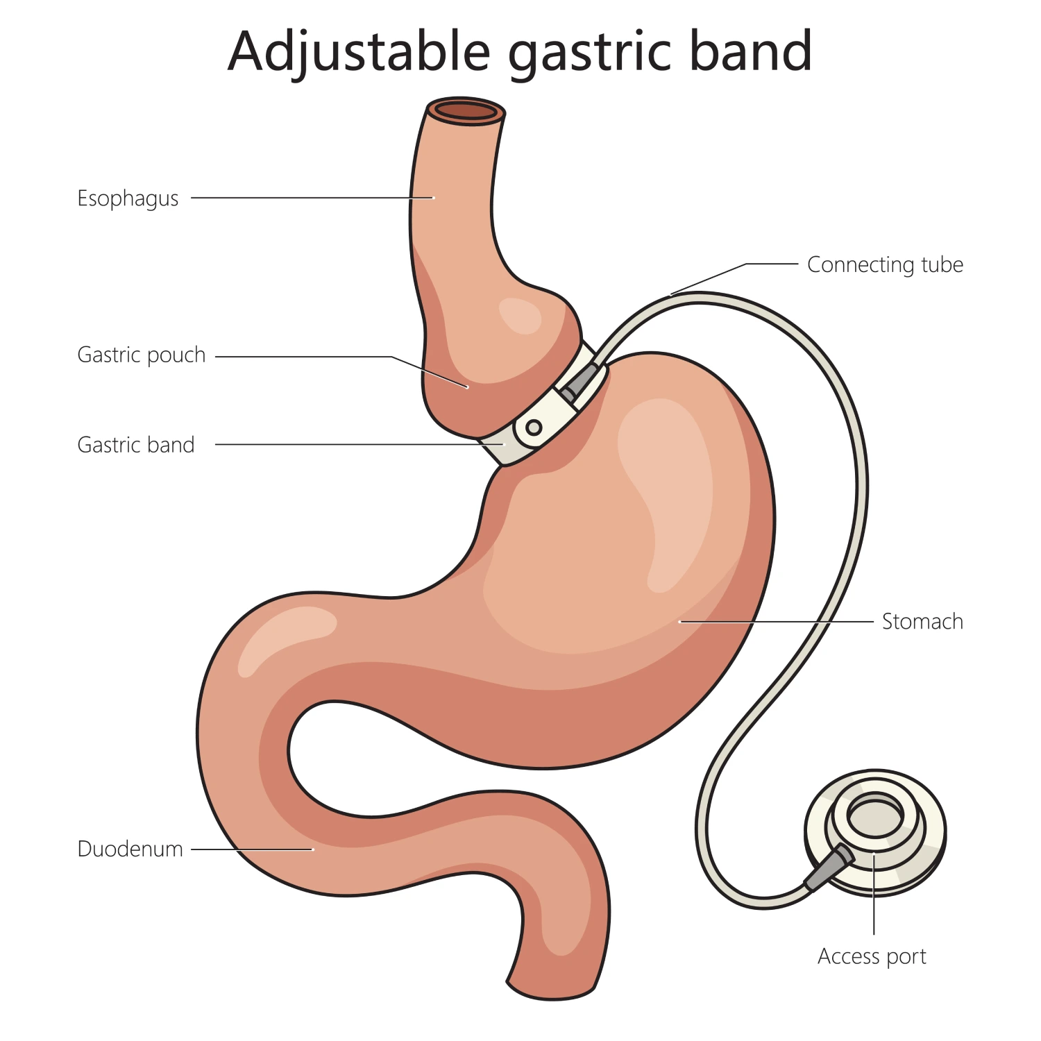 Gastric Band Removal in Dubai - Costs, Surgeon Credentials, Hospital Options, and Recovery Timeline