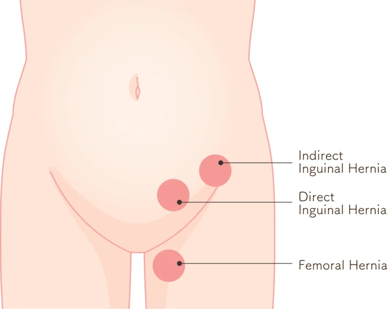 Inguinal Hernia Surgery in Dubai