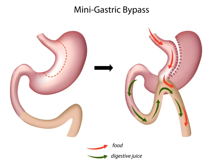 Mini gastric bypass surgery in UAE