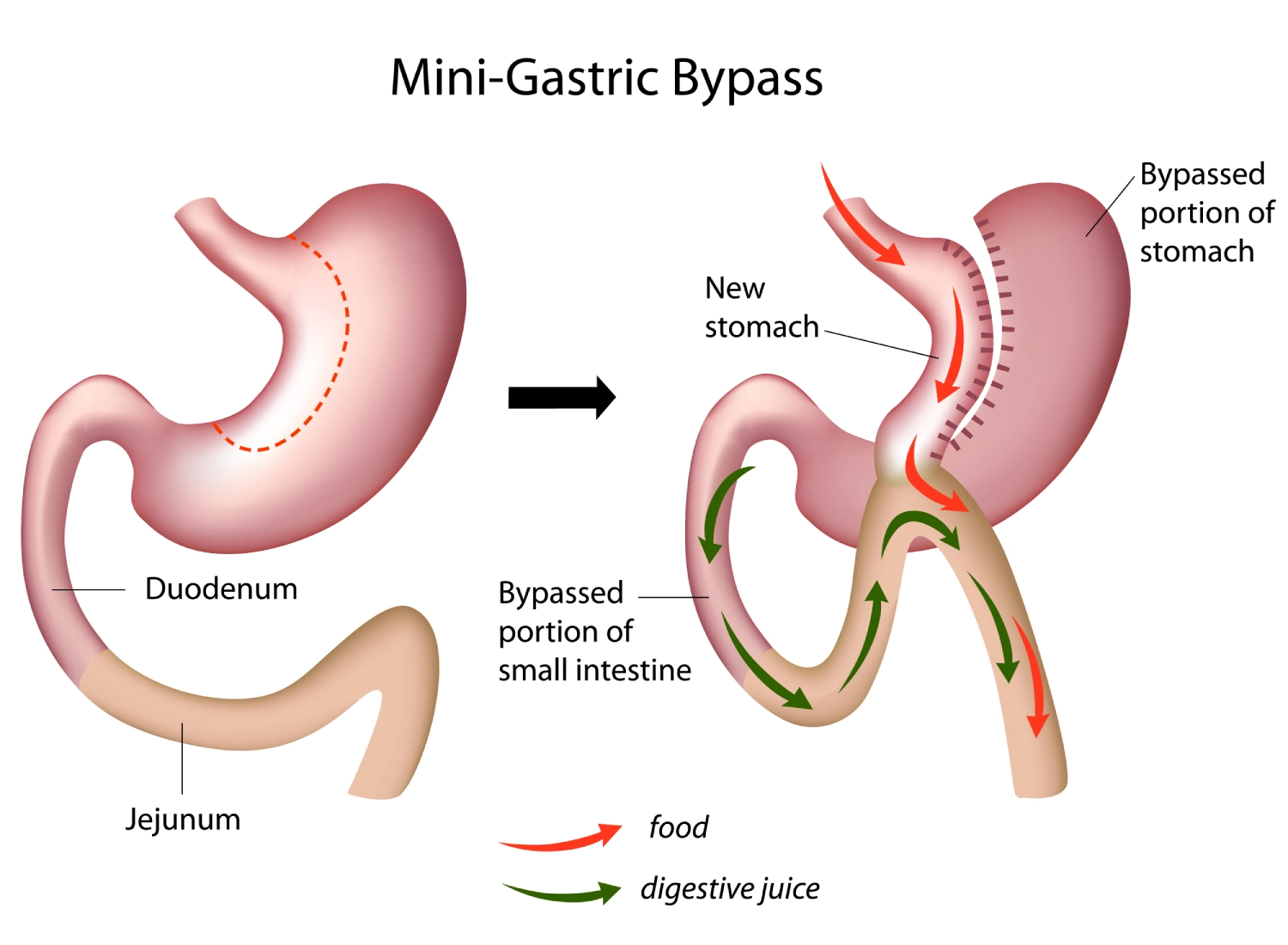 Mini-Gastric Bypass Risks and Complications: Reflux, Dumping Syndrome, Ulcers, and Malabsorption