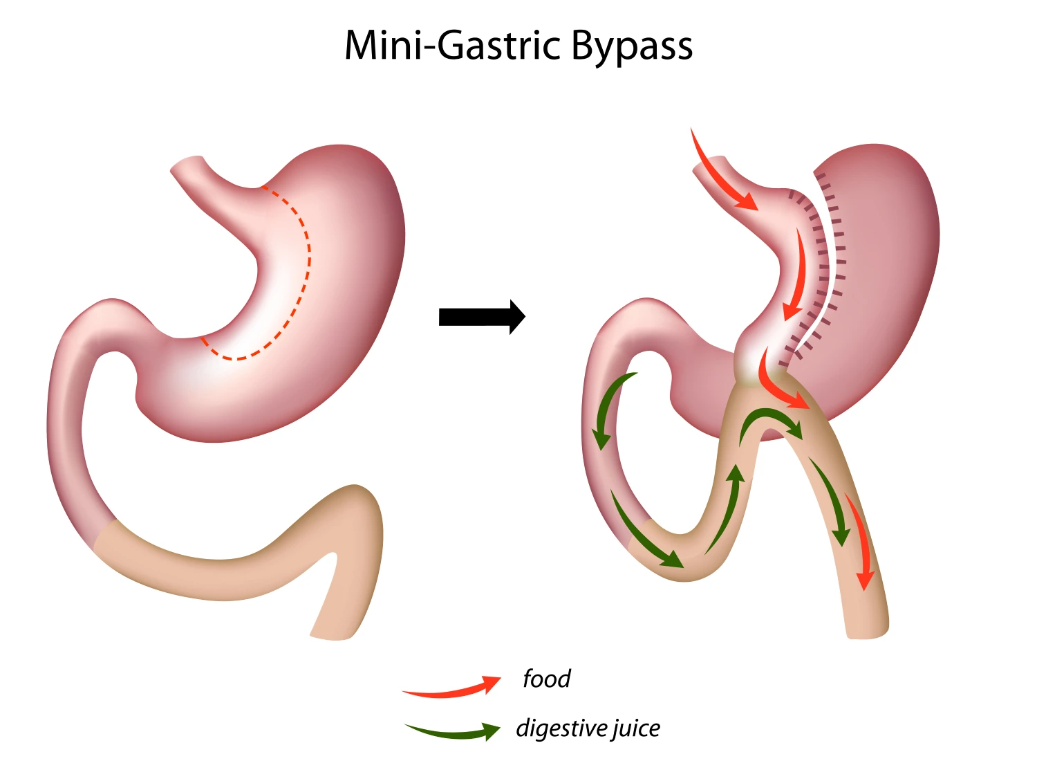 Mini gastric bypass surgery in UAE