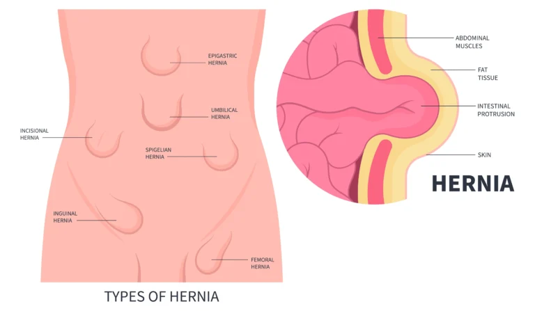 Preventing Hernia Recurrence: Post-Surgical Care and Lifestyle Modifications