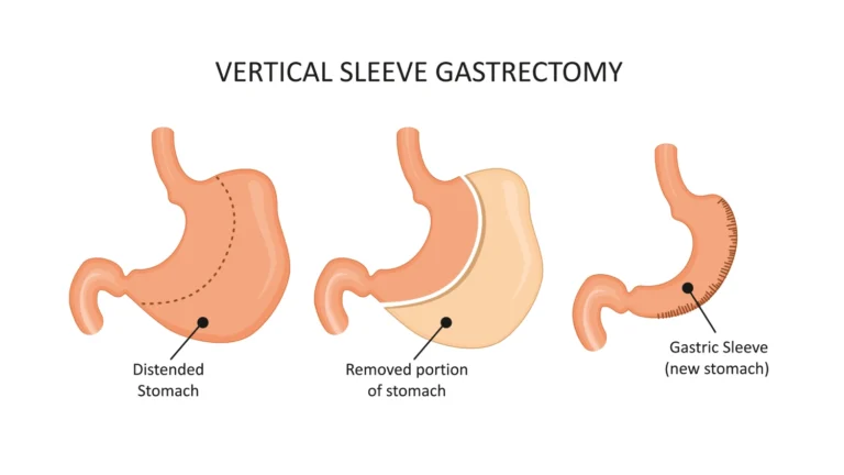 Risks After Sleeve Gastrectomy