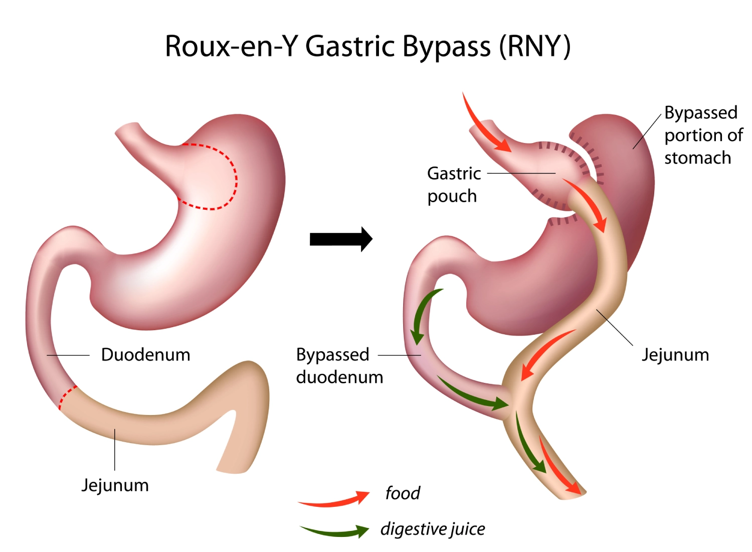 Roux-en-Y Gastric Bypass (RNY) surgery