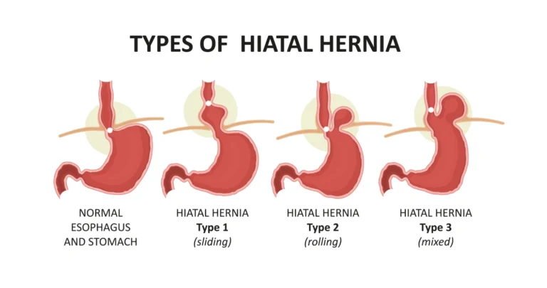 Cameron Lesions and Paraoesophageal Hernia: Understanding Bleeding Complications