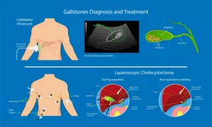Post-Cholecystectomy Syndrome: Managing Long-Term Digestive Changes