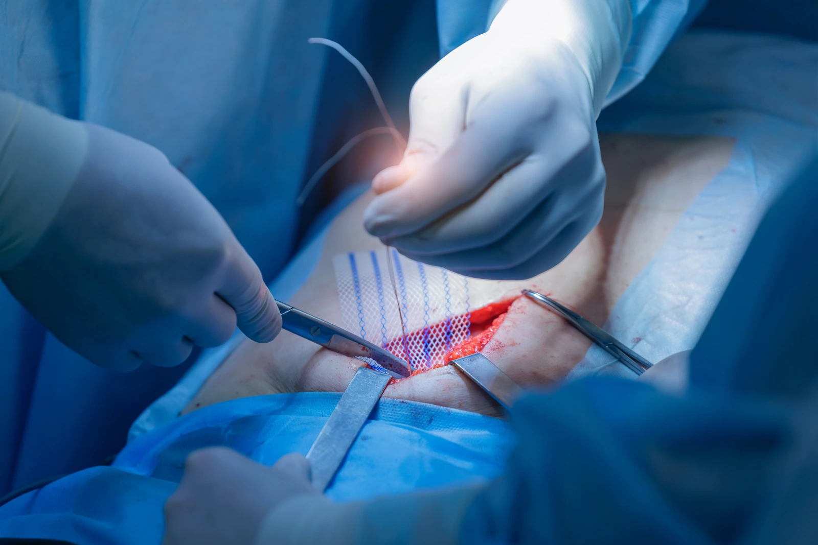 Surgeons performing abdominal surgery with mesh insertion after umbilical hernia removal