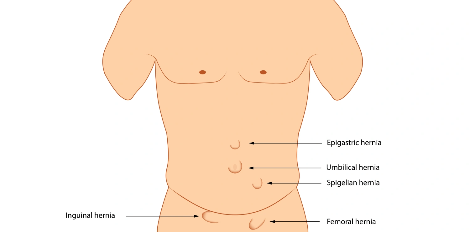 Types of hernia. Anatomy hernia illustration