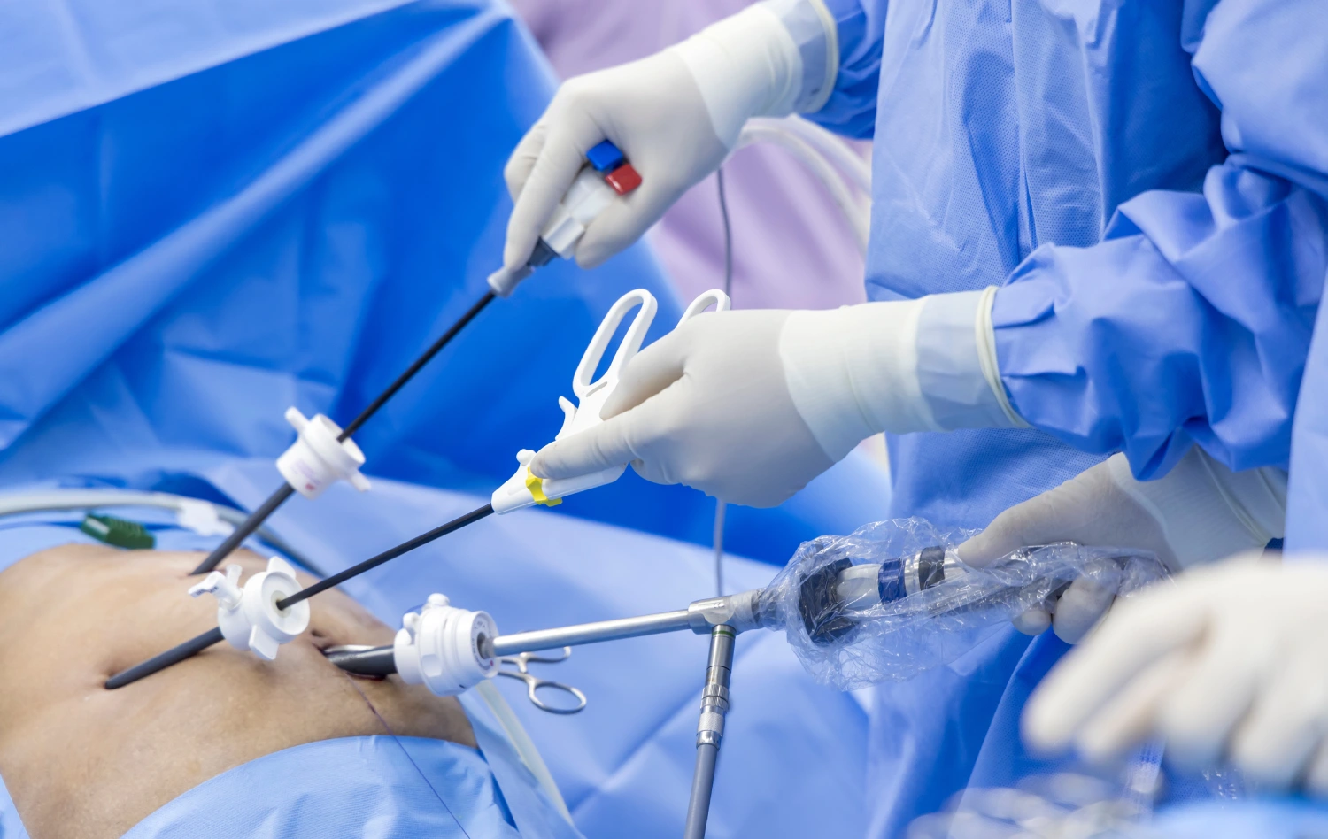 surgeons team during operation with surgical laparoscopy instruments