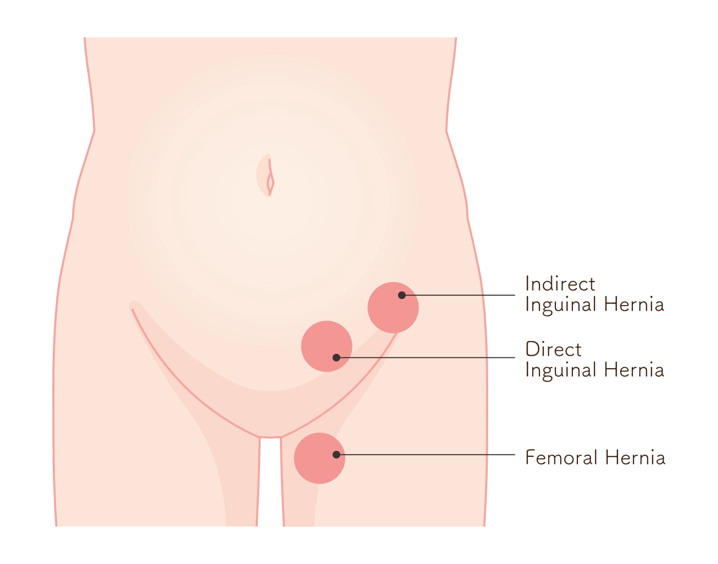Groin Hernia Symptoms - How to Recognize Inguinal and Femoral Hernias