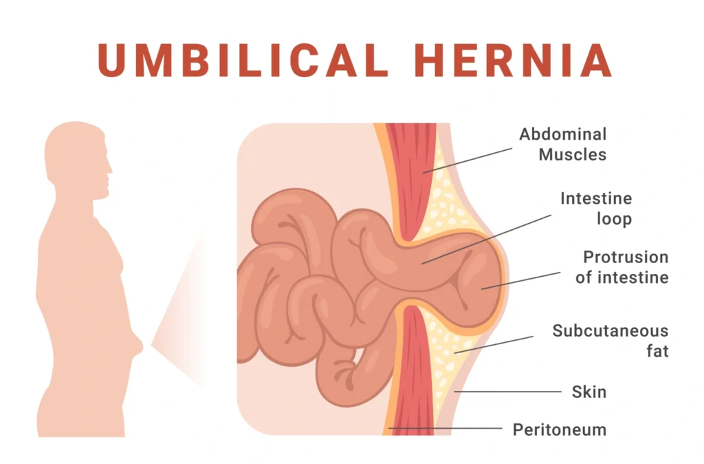 Infographics related to understanding the anatomy of an umbilical hernia
